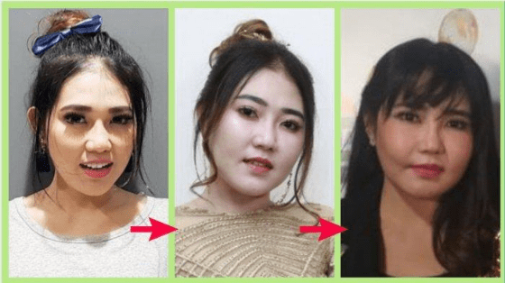 Sempat Dikira Operasi Plastik Inilah 6 Potret Perubahan Via Vallen